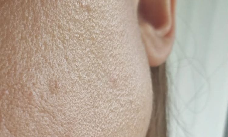 Zmiana tekstury skóry po laserze frakcyjnym - 83872