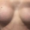 Asymetria piersi po powiększaniu