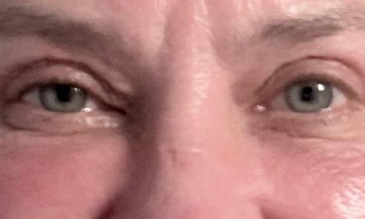 Asymetria po plastyce powiek - 83933