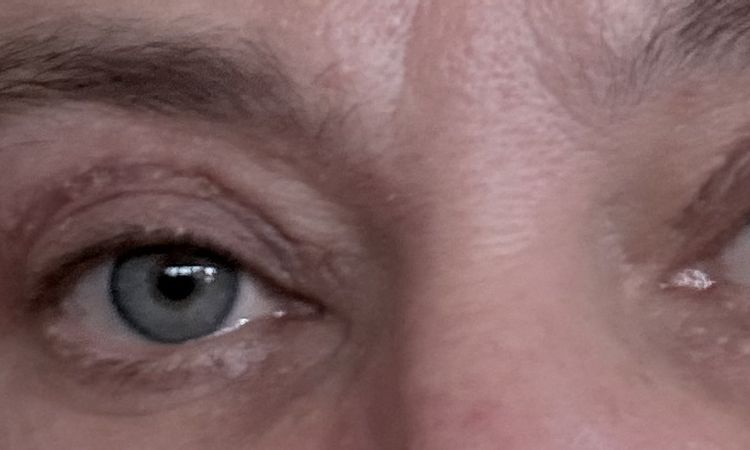 Asymetria po plastyce powiek - 83934