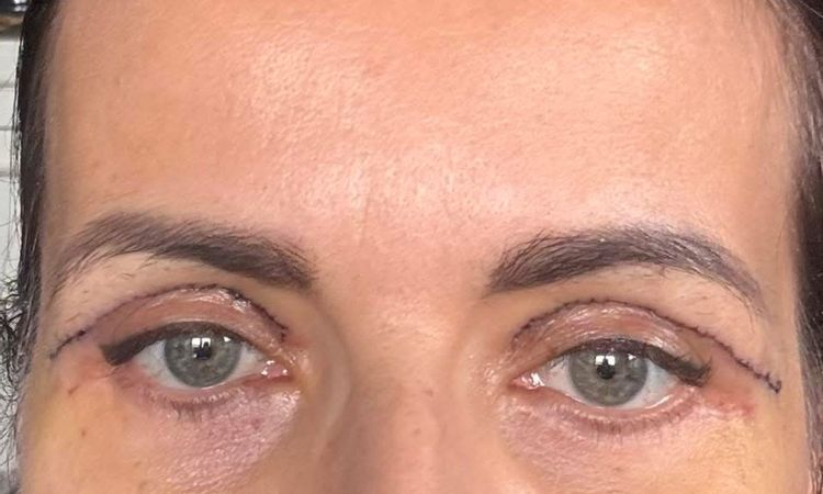 Blefaroplastyka szwy - 83955