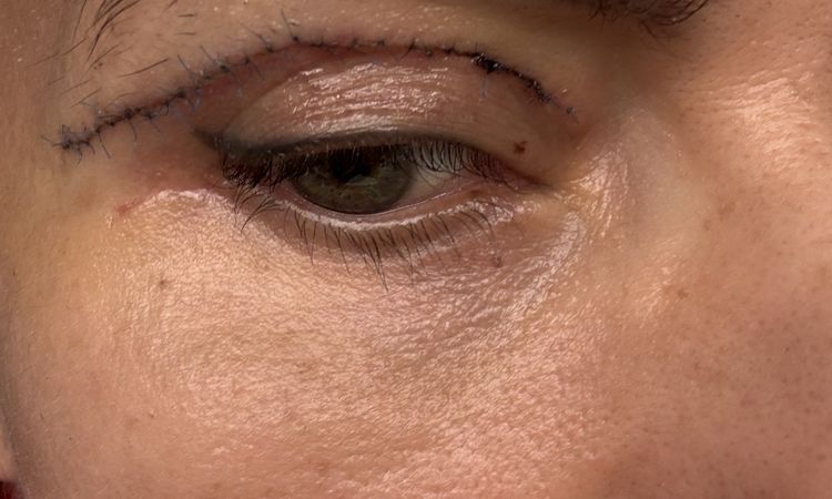 Blefaroplastyka szwy - 83956