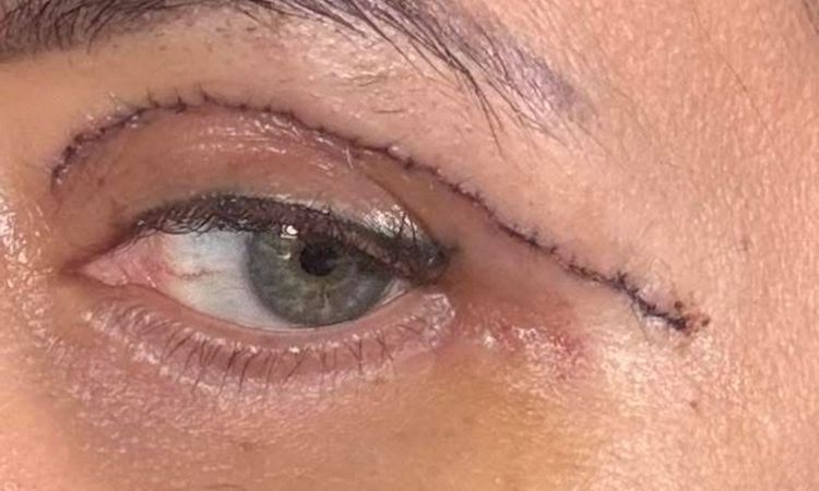 Blefaroplastyka szwy - 83957