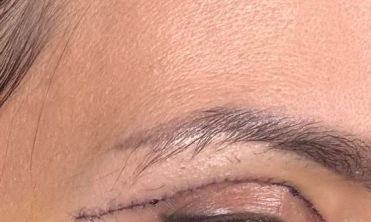 Blefaroplastyka szwy - 83958