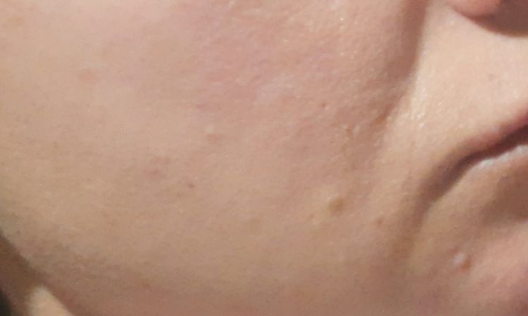 Ból policzka po kwasie hialuronowym - 83984