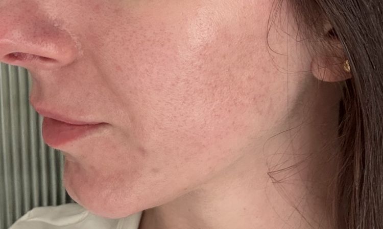 Brak efektów lasera na  rumień - 84143