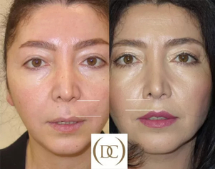 Lip lift - przed i po