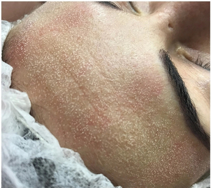 Przebieg mikrodermabrazji