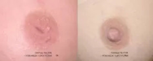Korekcja wciągniętych brodawek: przed i po