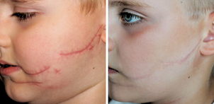 Usuwanie blizn - efekty