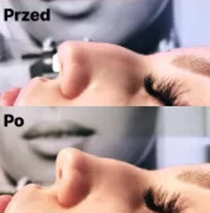 Korekta garbka nosa kwasem hialuronowym