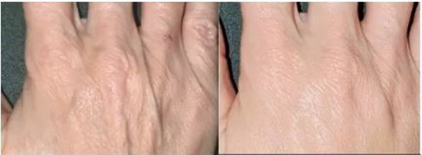 Odmładzanie skóry dłoni preparatem Radiesse - dr Katarzyna Mudel, Ars Estetica