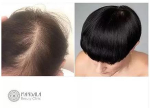 Przeszczepy włosów u kobiet efekty