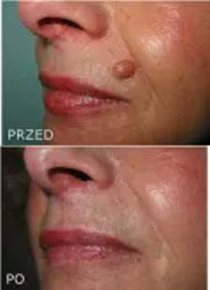 Laserowe usuwanie zmian skórnych: przed i po