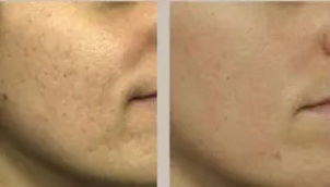 Laserowe leczenie trądziku: przed i po