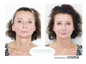 Nici liftingujące - przed i po