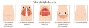 Schemat całkowitej plastyki brzucha