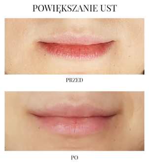 Powiększanie ust - przed i po