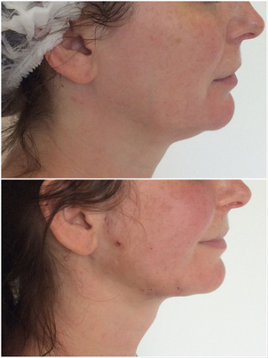 Korekta podwójnego podbródka - efekty