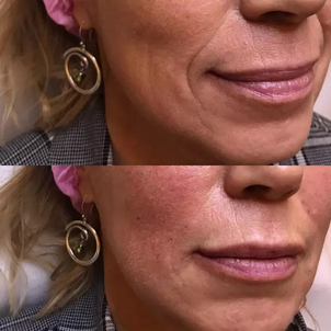 Wypełnianie zmarszczek kwasem hialuronowym przed i po