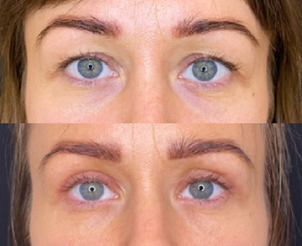 Blefaroplastyka: przed i po