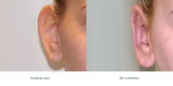 Korekta uszu – przed i po 