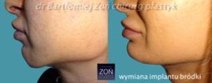 Implanty bródki - efekty
