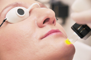 Zamykanie naczynek IPL