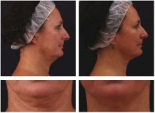 Efekty mezoterapii bezigłowej (Art Vein)