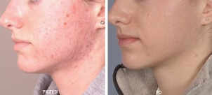 Terapia przeciwtrądzikowa przed i po