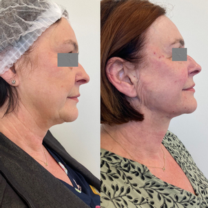 Nici liftingujące - podwójny podbródek