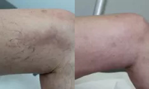 Efekty skleroterapii