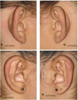 Plastyka uszu - efekty
