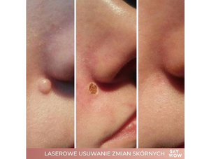 Efekty usuwania brodawek