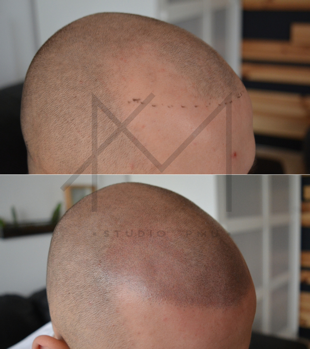 Mikropigmentacja włosów: przed i po