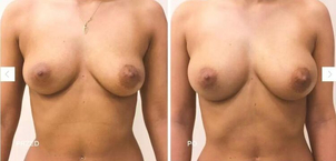 Powiększanie piersi tłuszczem