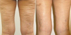 Efekty termoliftingu: lifting skóry ud