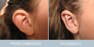 Korekta uszu – metamorfoza