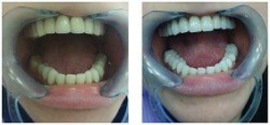 Licówki: przed i po