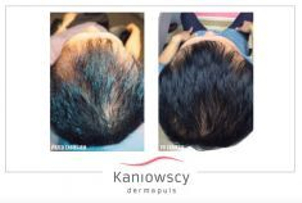 Leczenie łysienia - przed i po