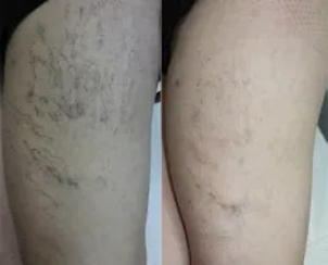 Efekty laserowego leczenia żylaków
