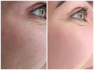 Laseroterapia: przed i po