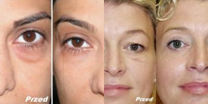 Karboksyterapia - efekty