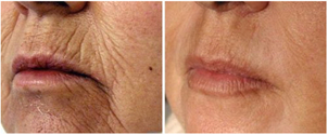 Laseroterapia – efekty
