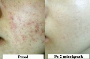 Mezoterapia igłowa twarzy: przed i po (lek. med. Iwona Jaworska)