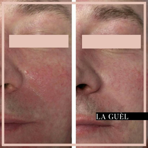 Leczenie rumienia światłem IPL - efekty