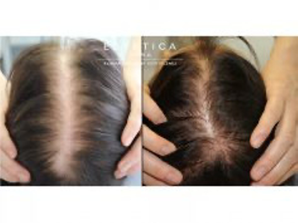 Leczenie alopecji - efekty