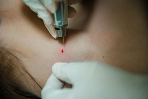 Laserowe usuwanie brodawek