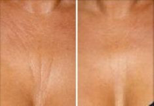 Laserowe usuwanie blizn: efekty