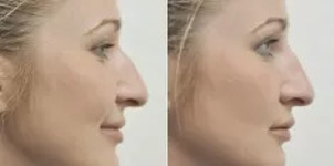 Efekty modelowania nosa kwasem hialuronowym